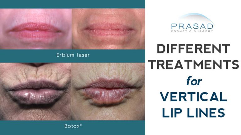 different treatments for wrinkles above lips