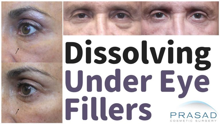 under eye fillers gone wrong - dissolving under eye fillers