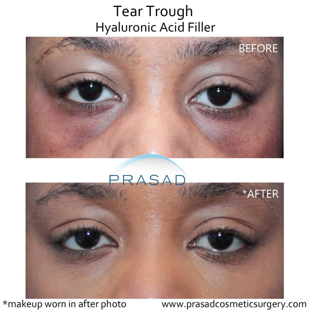 Benefits of PRP Injection Under Eyes Dr. Prasad New York