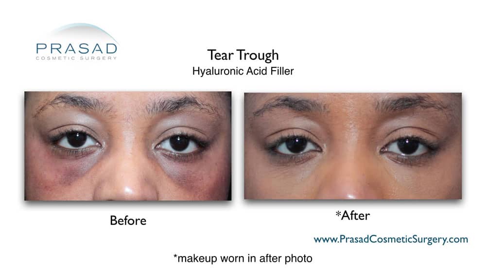 Under Eye Filler Before and After Photos - Prasad Cosmetic Surgery NY