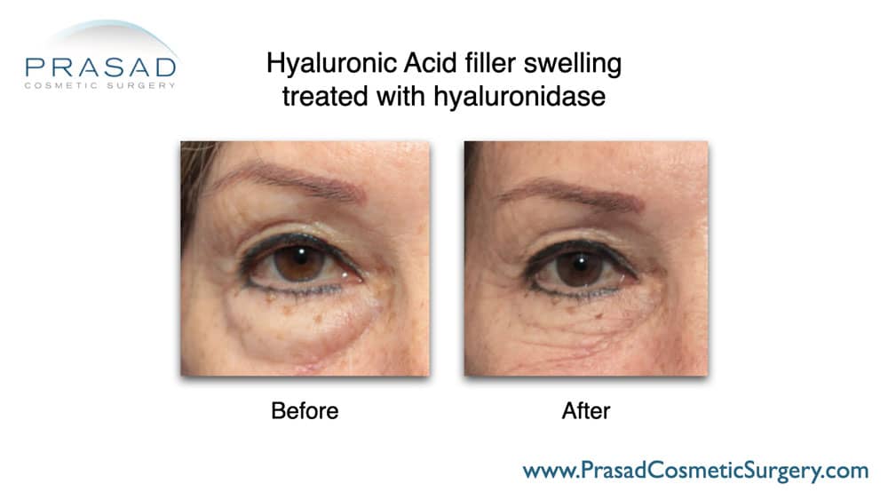 dissolving filler under eyes before and after