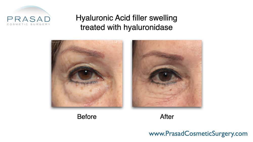 Under Eye Filler Before and After Photos - Prasad Cosmetic Surgery NY