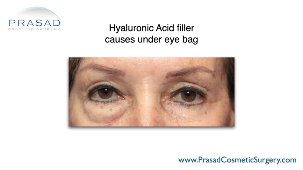 under eye filler gone wrong treated with hyaluronidase