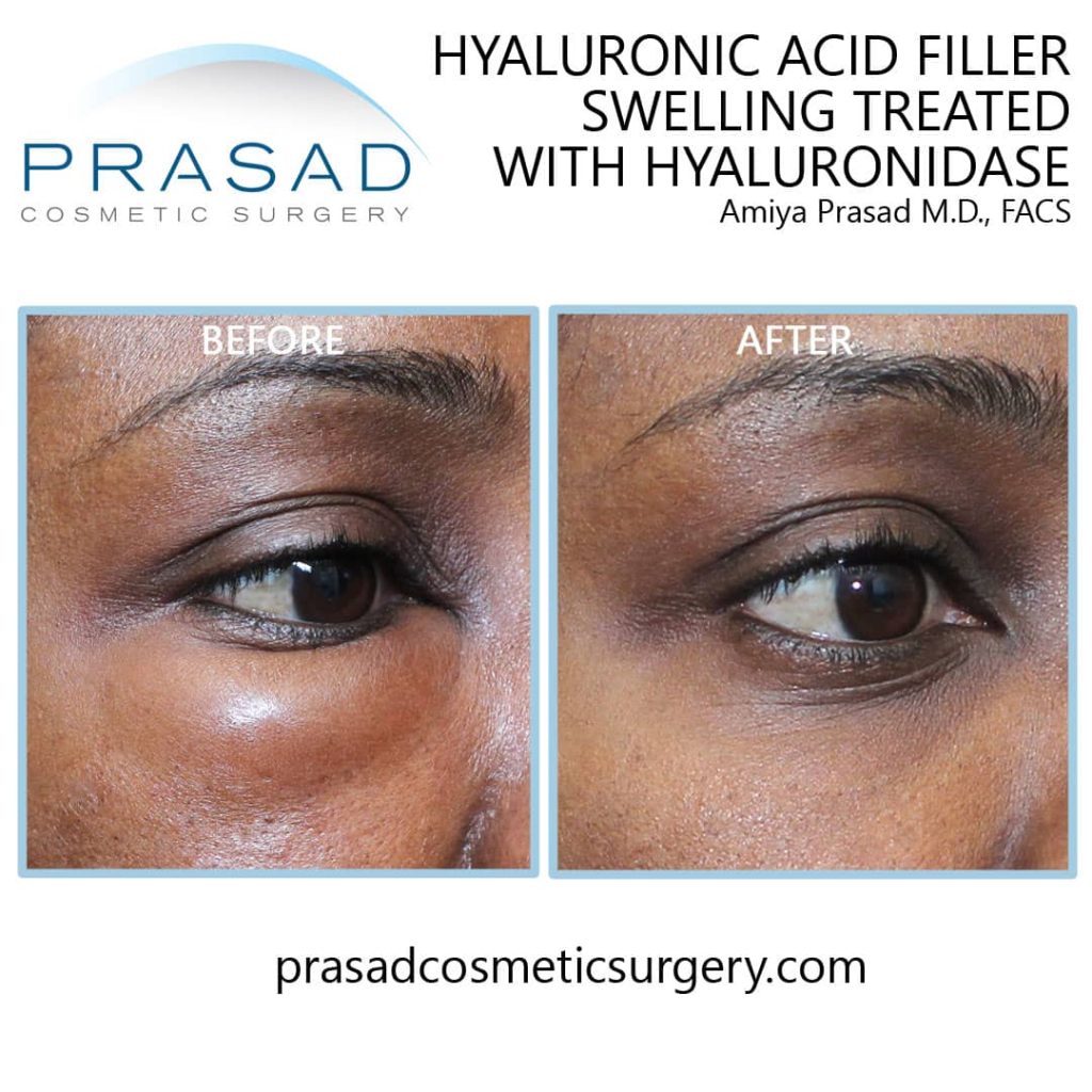 under eye filler gone wrong fix by Dr Prasad