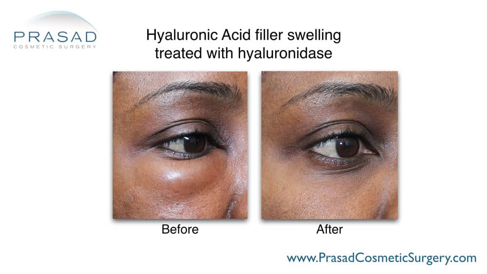 swelling after under eye filler fixed by Dr Prasad before and after