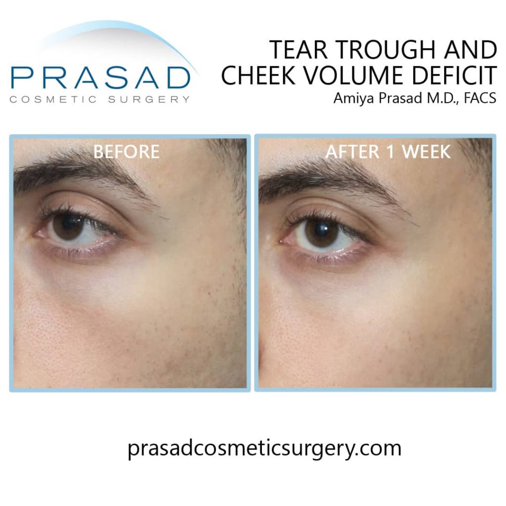 under eye and cheek filler before and after