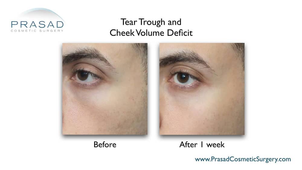 Under Eye Filler Before and After Photos - Prasad Cosmetic Surgery NY