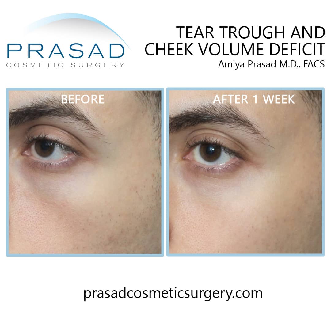 Under Eye Filler Before and After Photos - Prasad Cosmetic Surgery NY