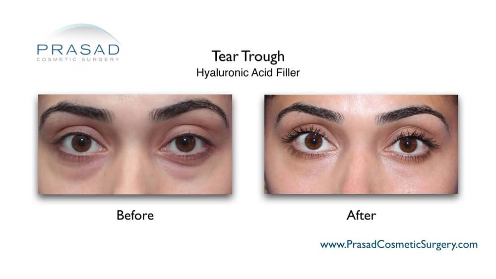 under eye filler before and after pictures