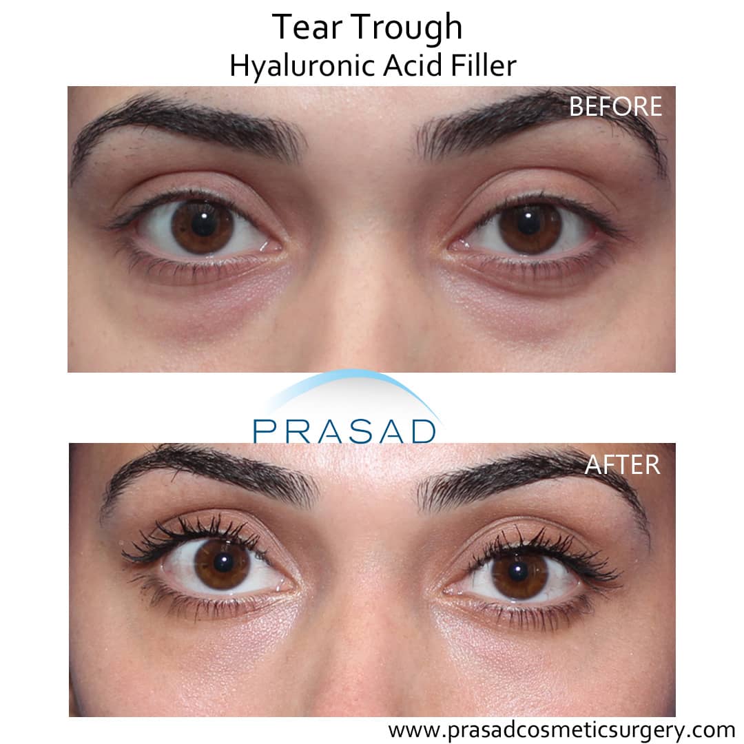 under eye trough filler before and after
