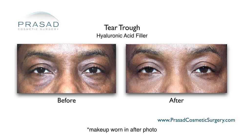 under eye bags filler before and after