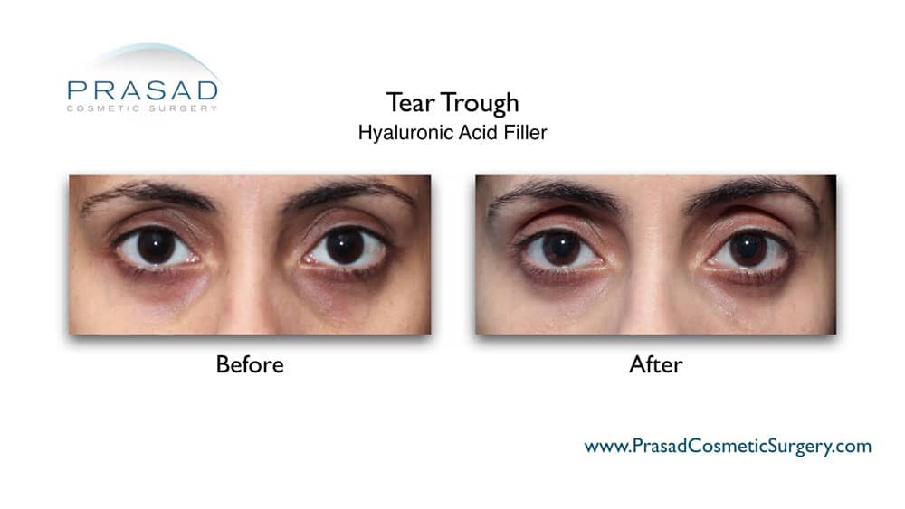 restylane under eye filler before and after