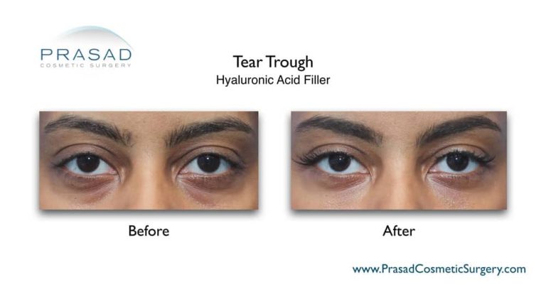 What is the best tear trough filler? | Dr. Prasad Blog