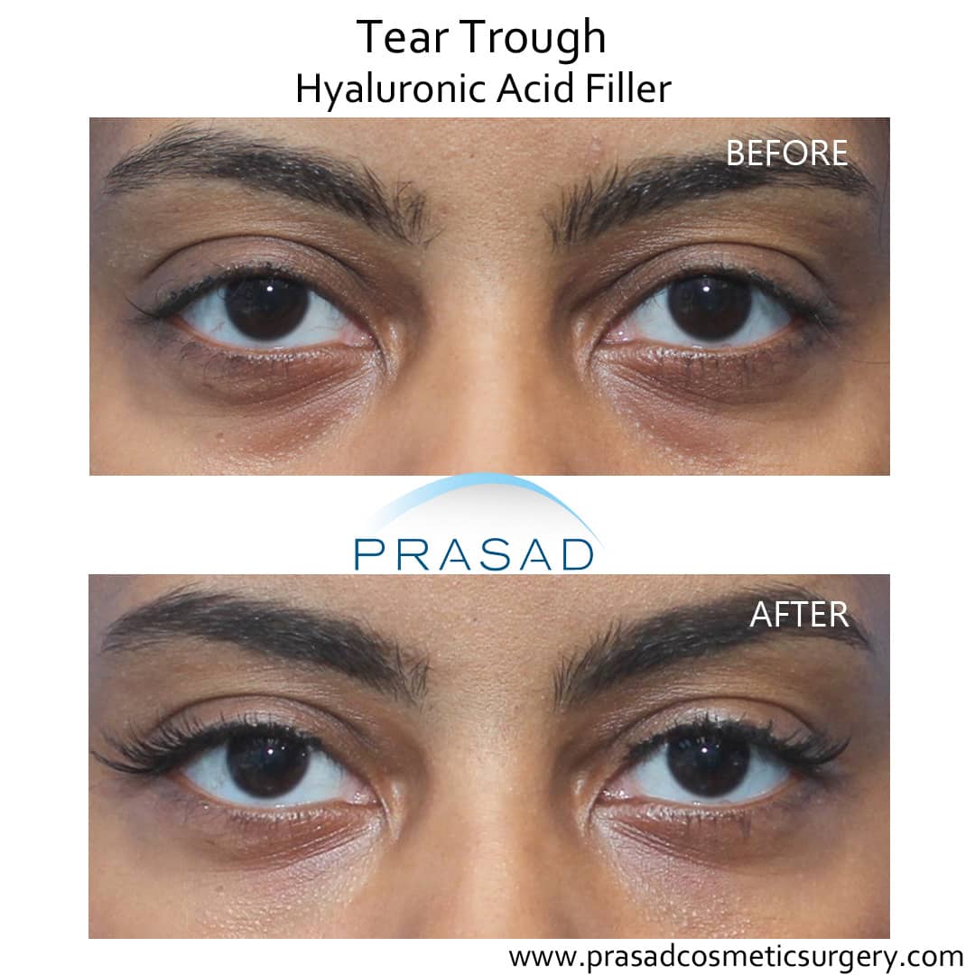 Under Eye Filler Before and After Photos - Prasad Cosmetic Surgery NY