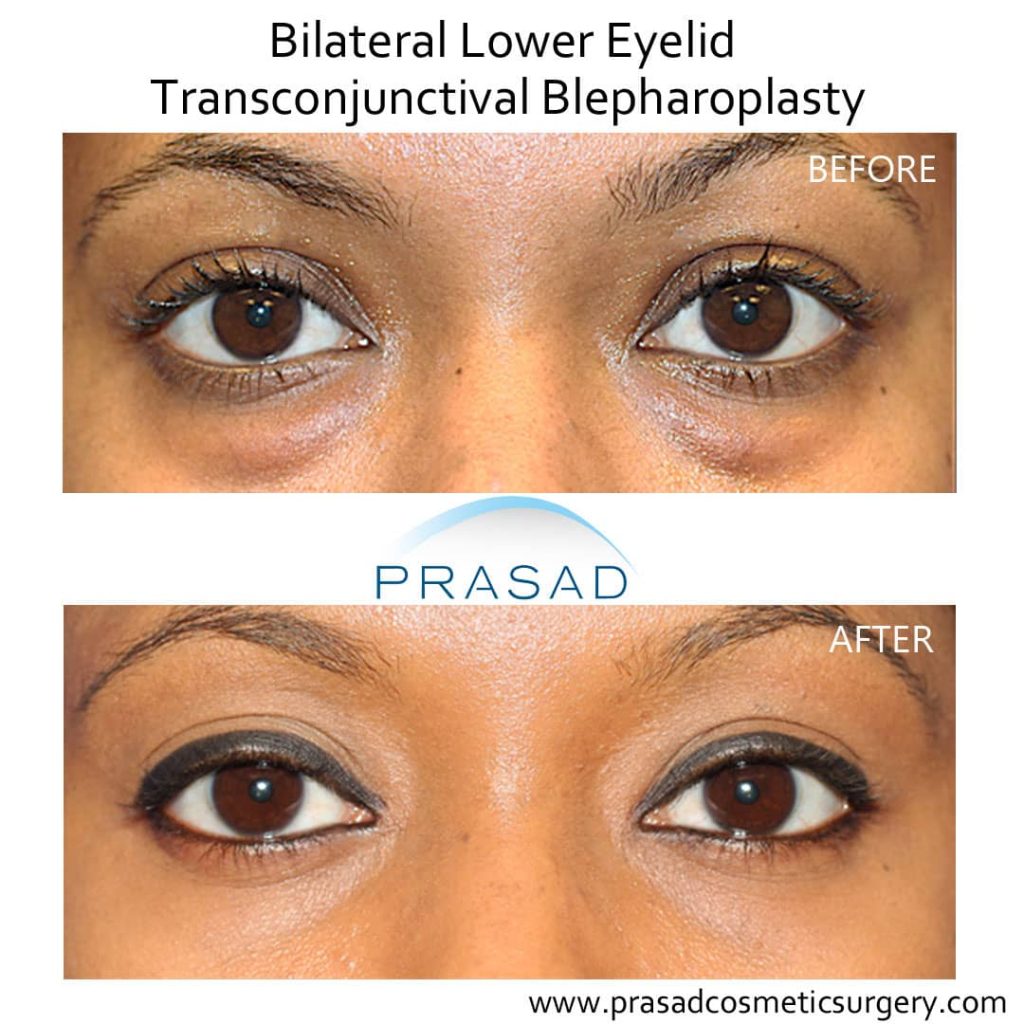 lower blepharoplasty before and after