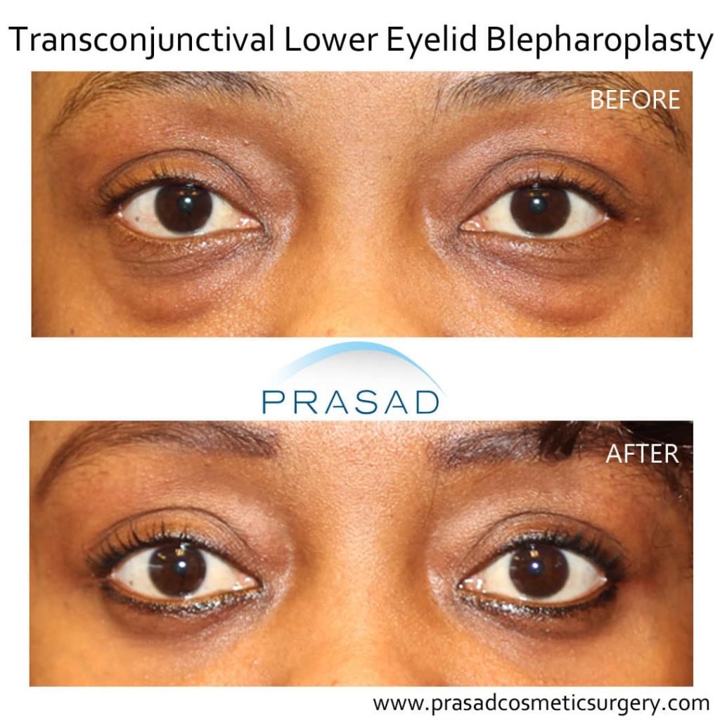 lower eyelid blepharoplasty before and after on dark-skin female patient