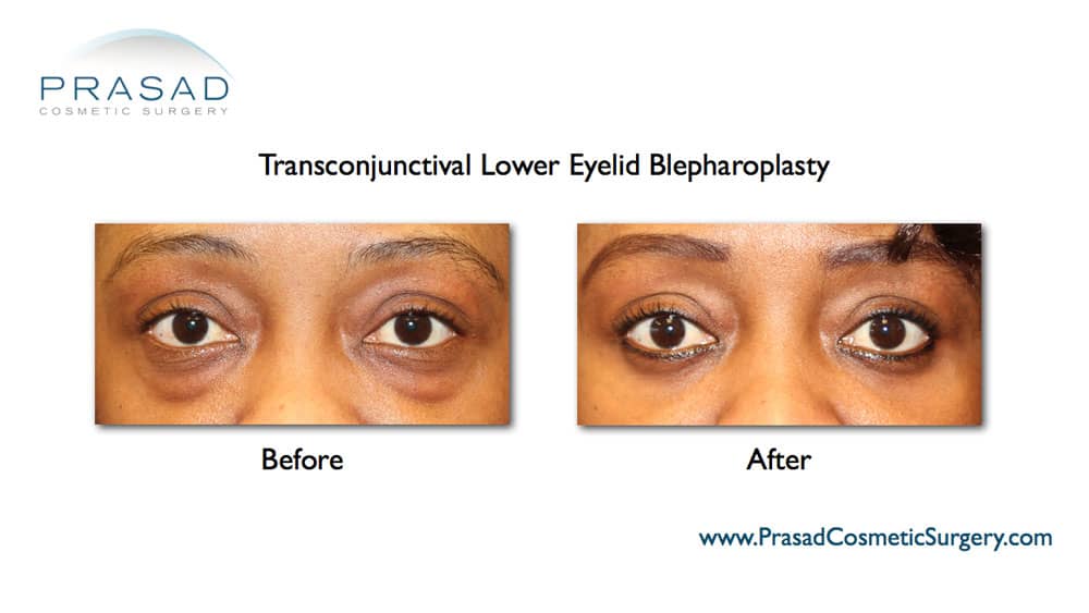 transconjunctival lower blepharoplasty before and after - african-american female patient