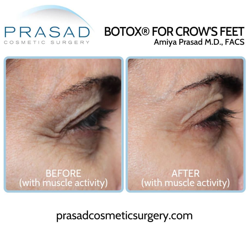 botox for under eye wrinkle treatment option before and after
