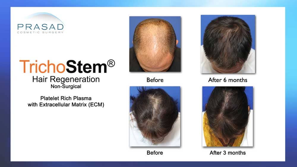 ACell+PRP for hair regeneration before and after