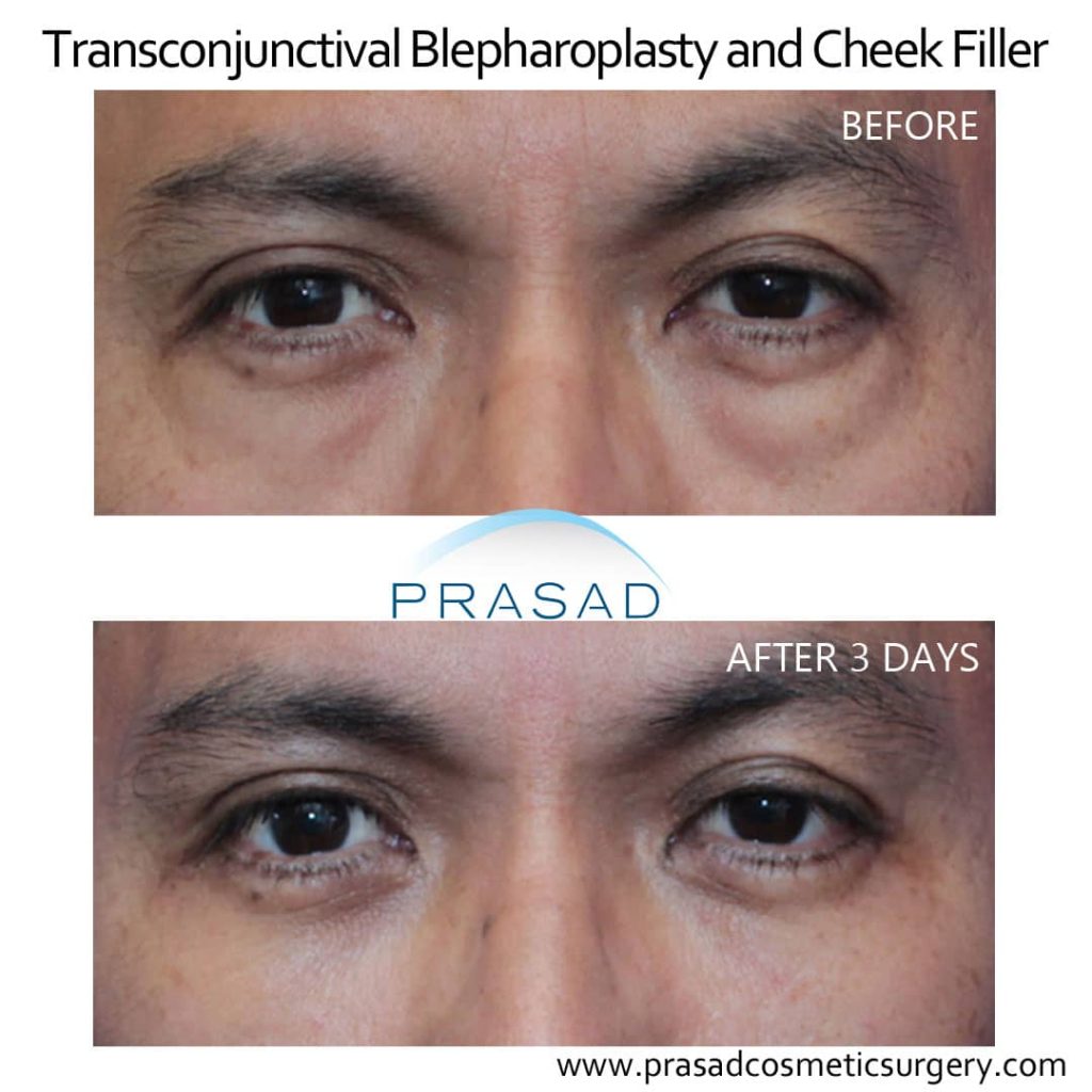 Blepharoplasty recovery deals