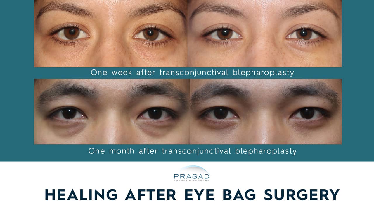 Lower Blepharoplasty Recovery Process  Dr Prasad Blog