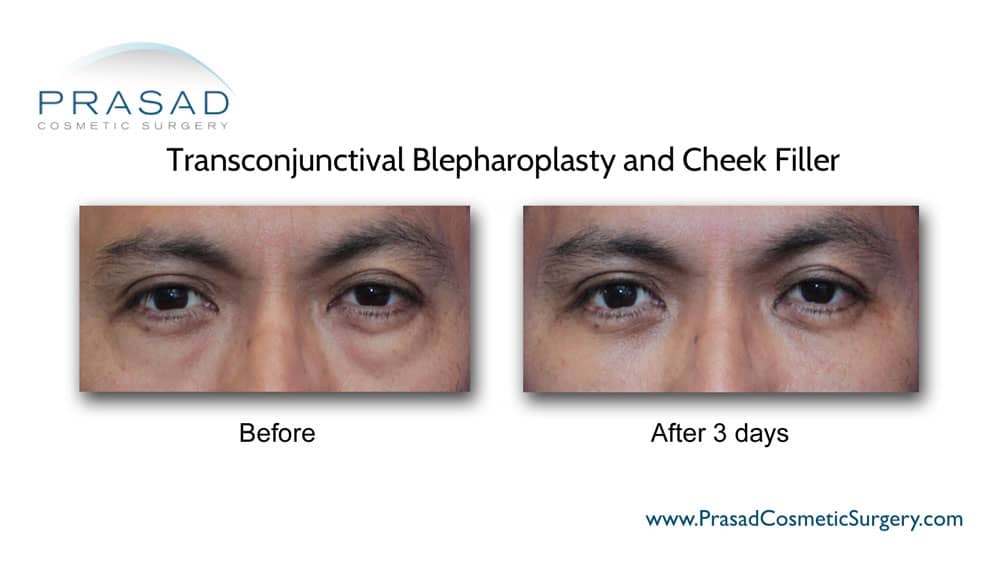 lower blepharoplasty recovery photos before and after 3 days