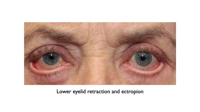 Complications from lower eyelid skin removal to treat wrinkles