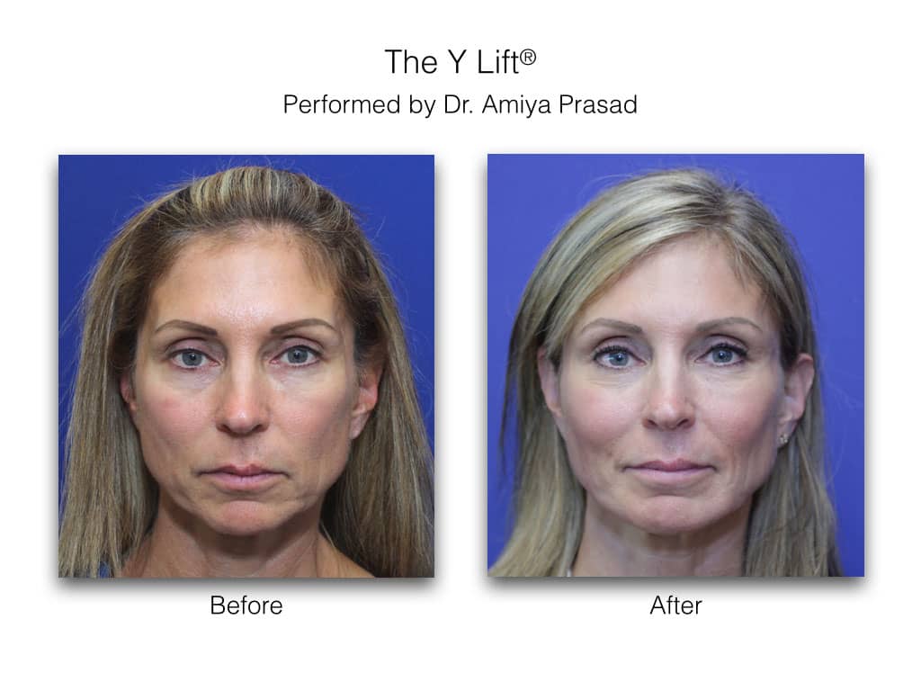 how Dr. Prasad avoid pillow face from fillers - liquid facelift or y lift before and after recovery