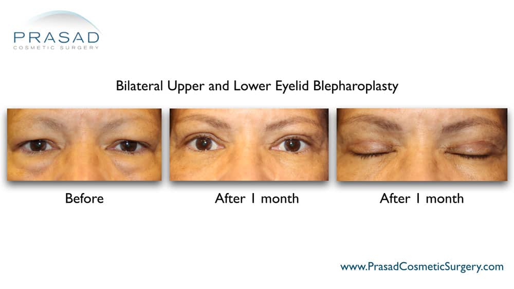 upper and lower eyelid blepharoplasty recovery after 1 month