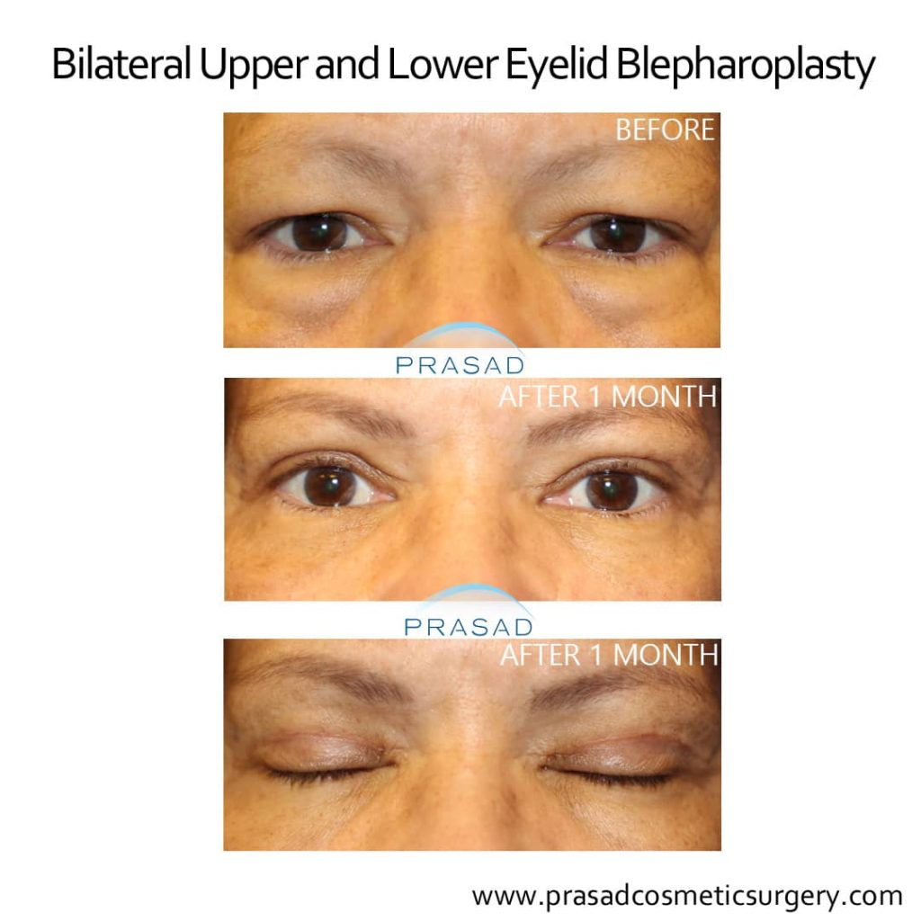 lower and upper eyelid blepharoplasty before and after 1 month recovery