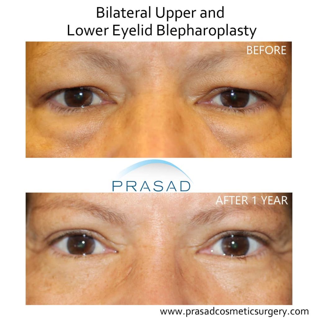 upper and lower blepharoplasty before and after full recovery
