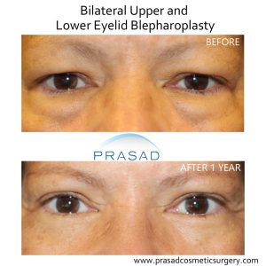 Upper Blepharoplasty / Upper Eyelid Surgery | Dr. Amiya Prasad