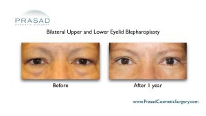 Upper Blepharoplasty / Upper Eyelid Surgery | Dr. Amiya Prasad