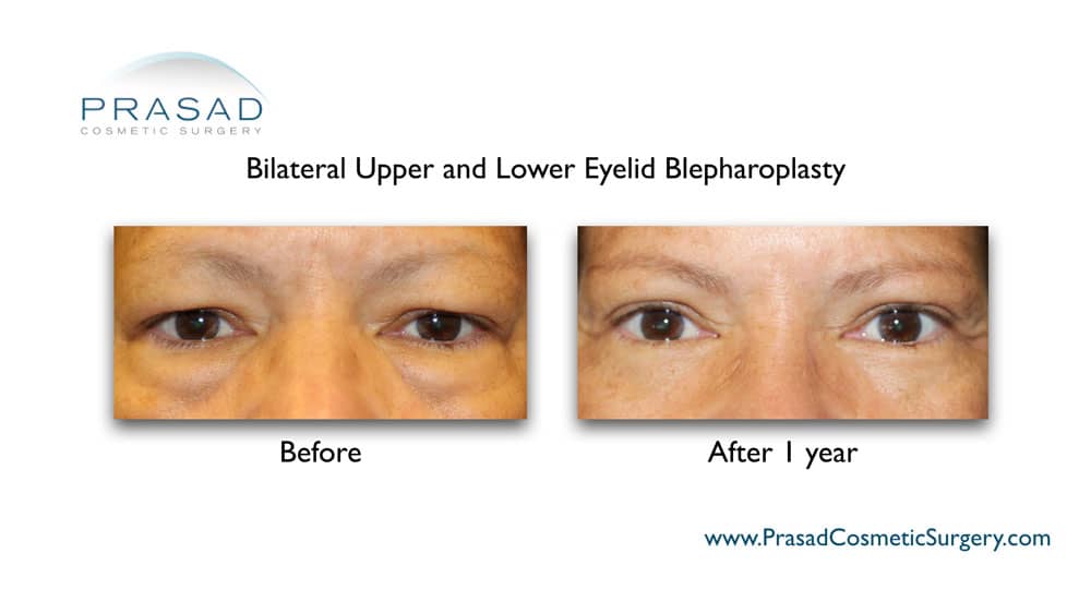 lower and upper blepharoplasty full recovery before and after 1 year