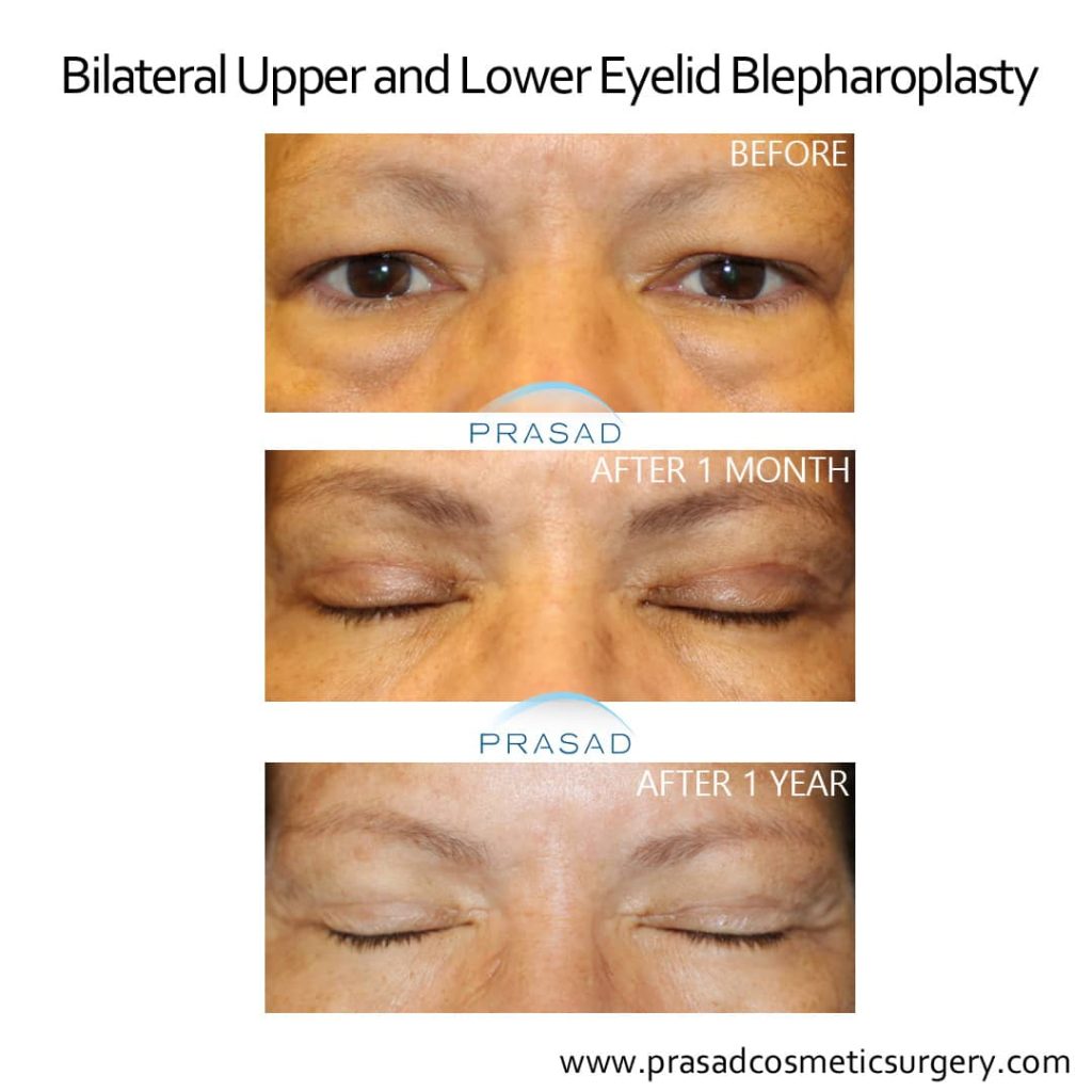 upper and lower eyelid surgery recovery photos 1 month and 1 year recovery