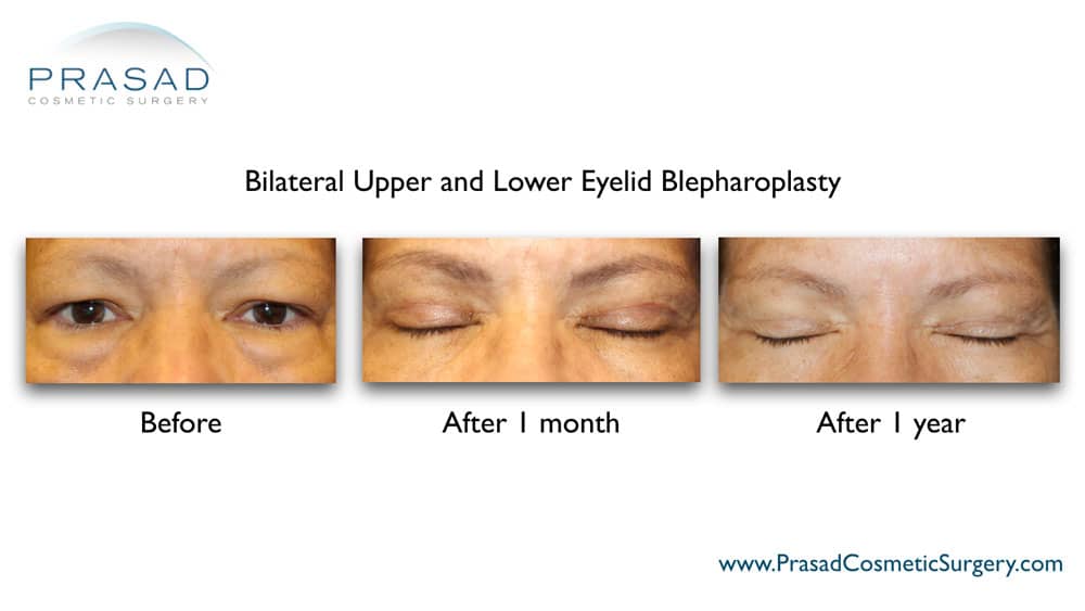 upper and lower eyelid blepharoplasty recovery suture healing after 1 month vs 1 year