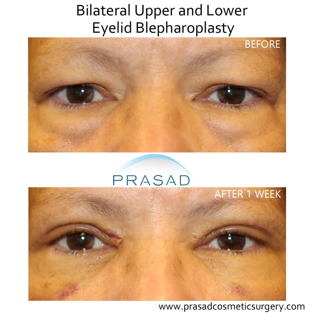 one week lower blepharoplasty recovery photos