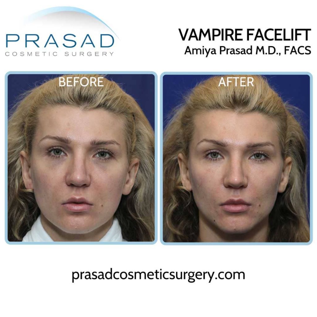 prp facial before and after / vampire facial before and after