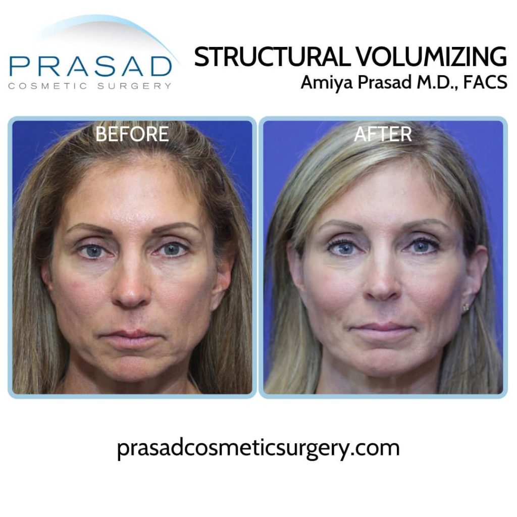 how Dr. Prasad avoid pillow face - y lift before and after recovery