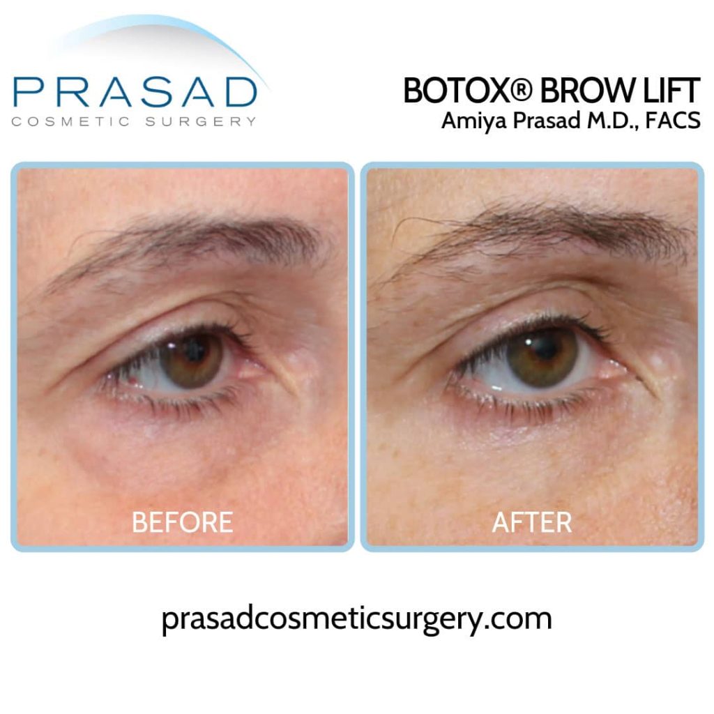 botox brow lift before and after