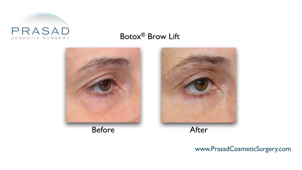 botox brow lift before and after treatment results