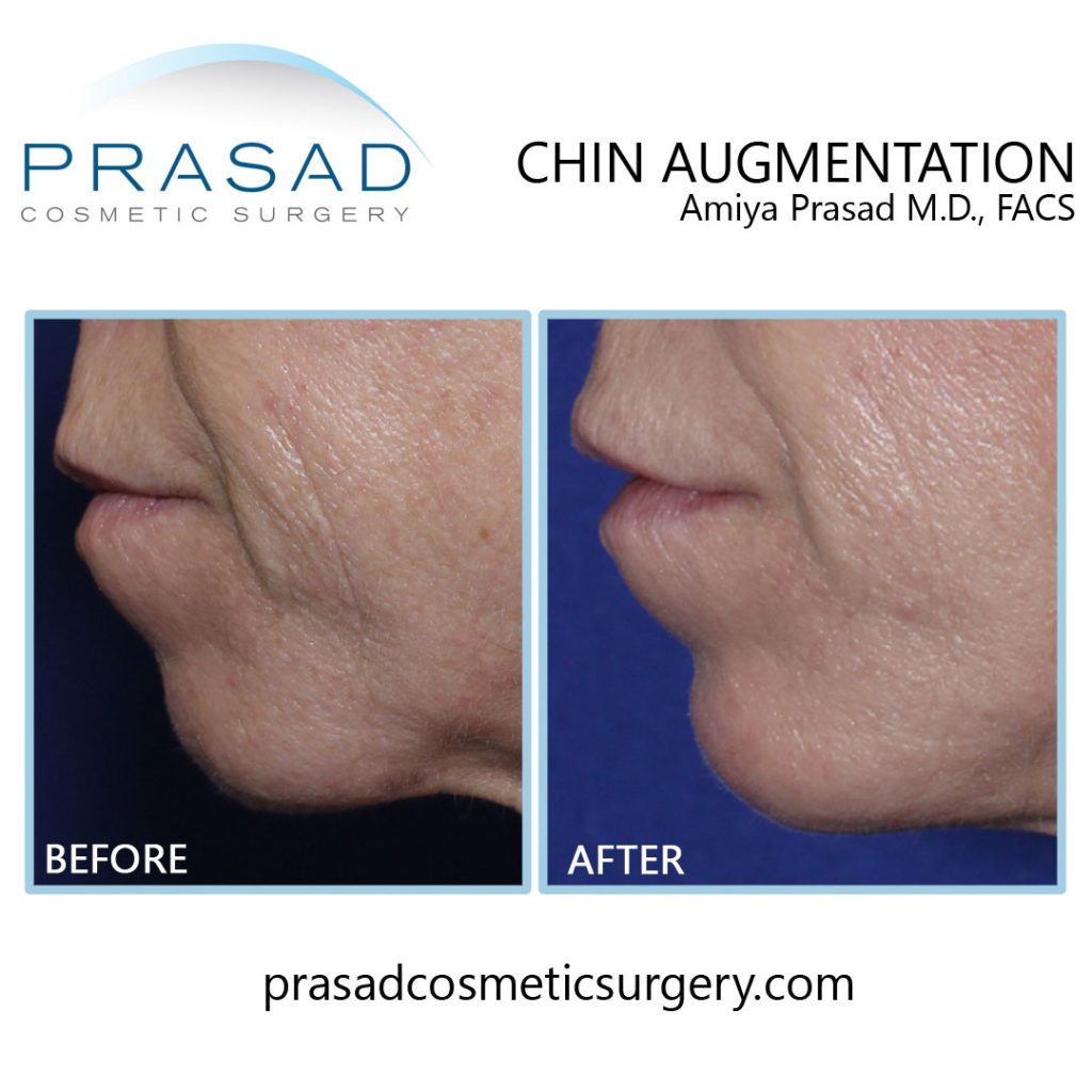 Chin Filler Before and After male patient side view