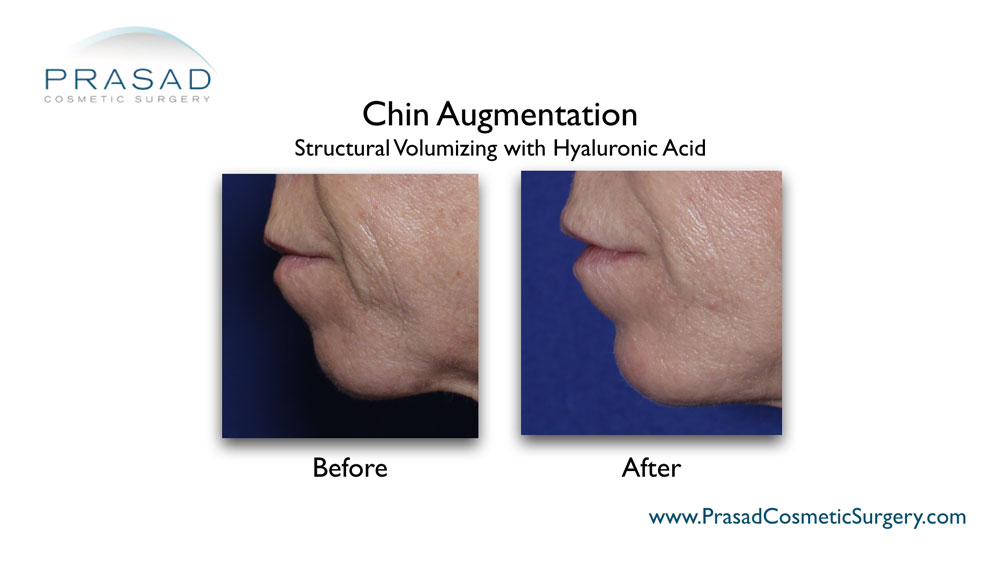 filler for chin before and after male