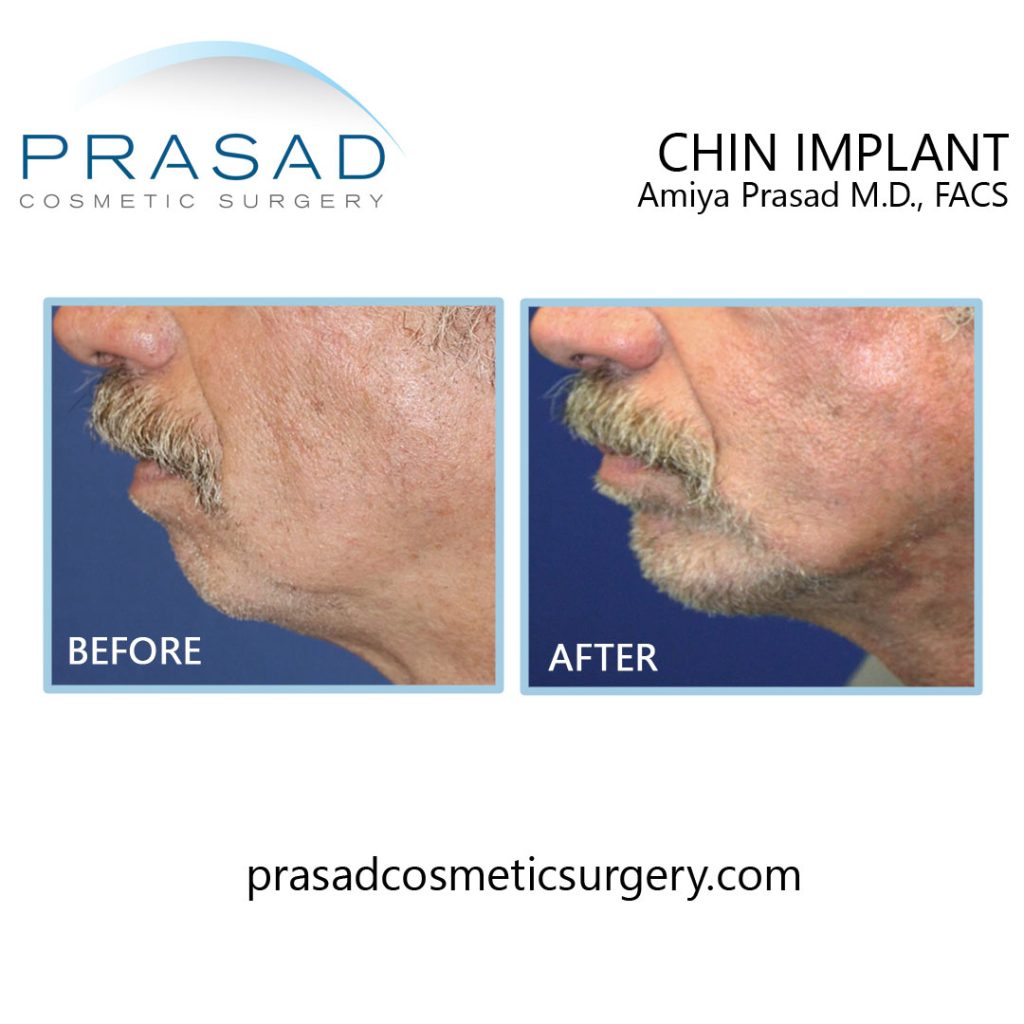 Chin implant before and after male