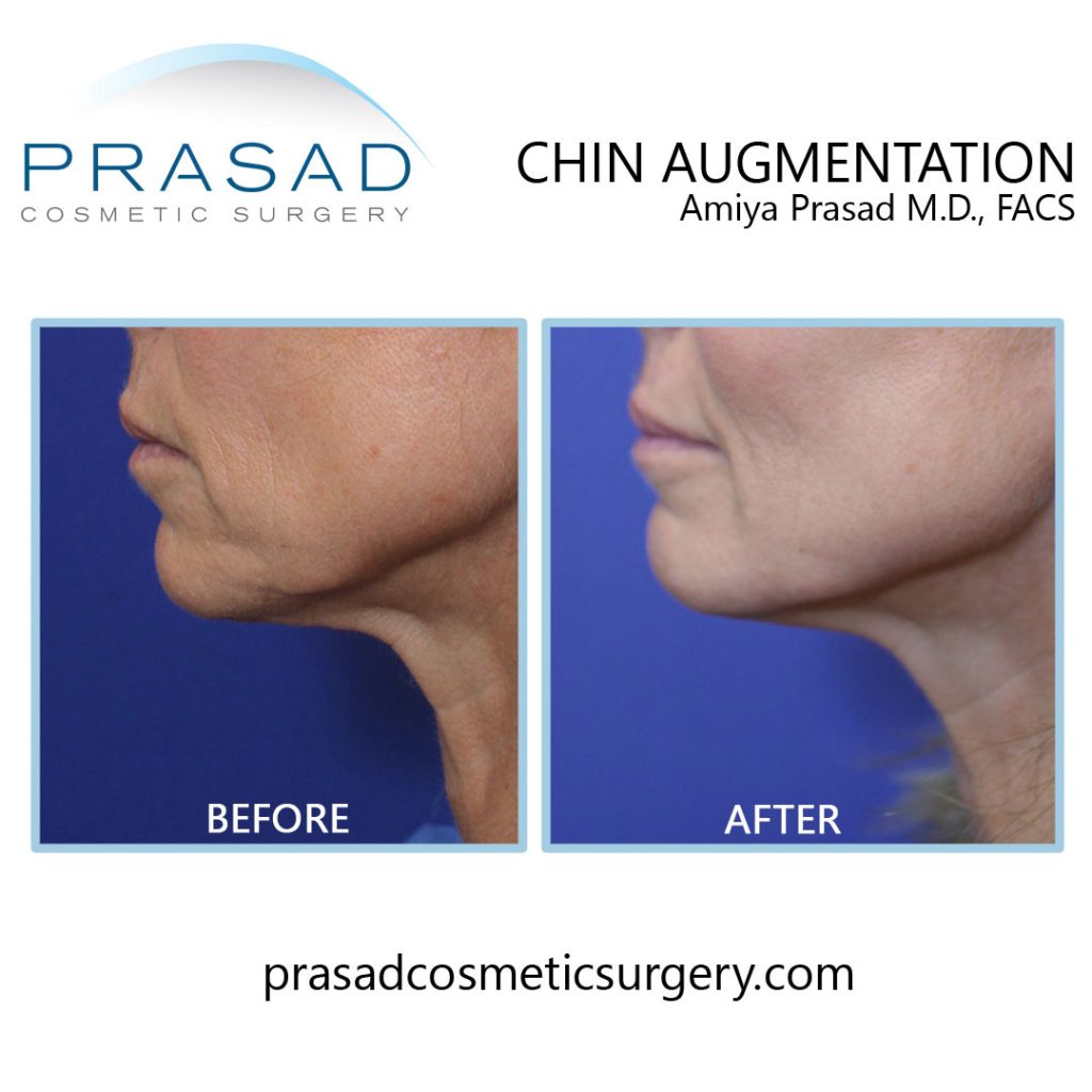 juvederm chin filler before and after female