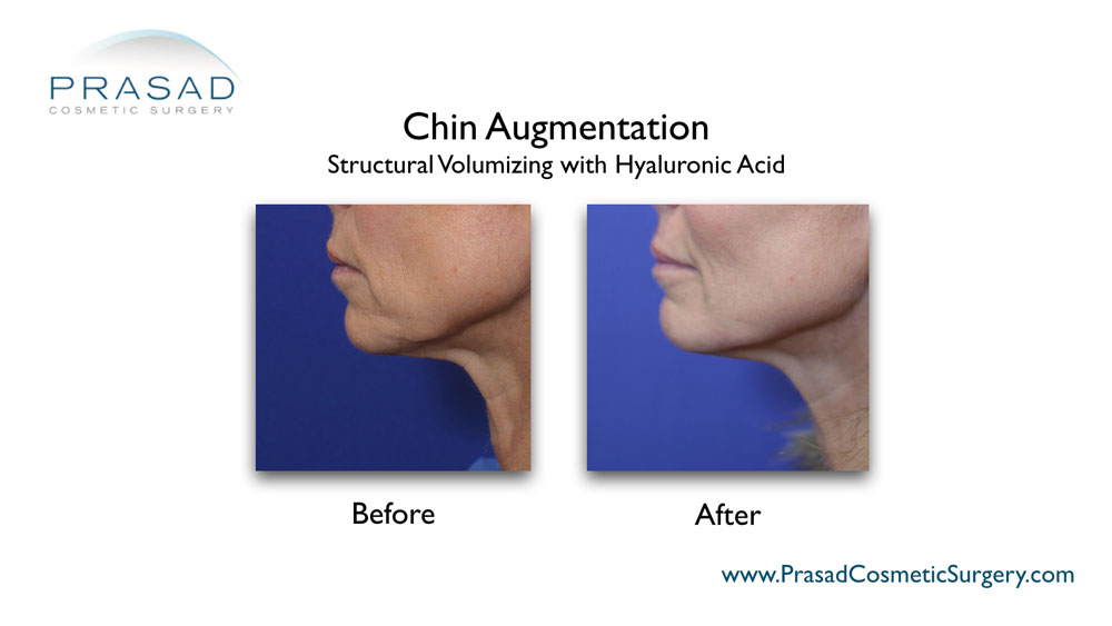 before and after chin filler female