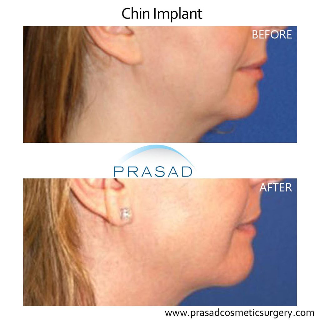 chin implant before and after female patient - full recovery