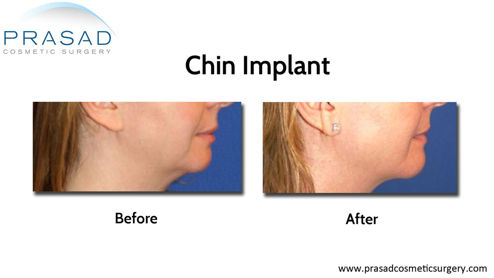 chin implant before and after female right side view