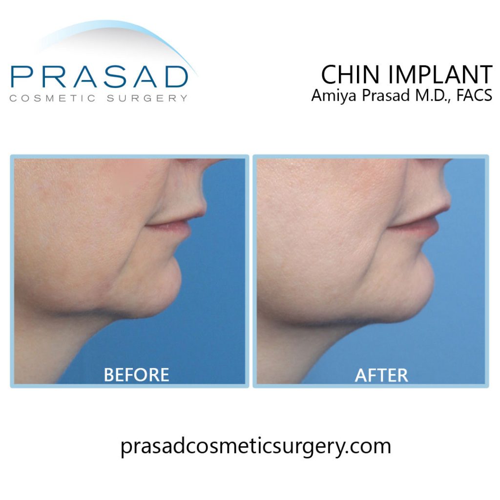 chin implant before and after full recovery female right side view