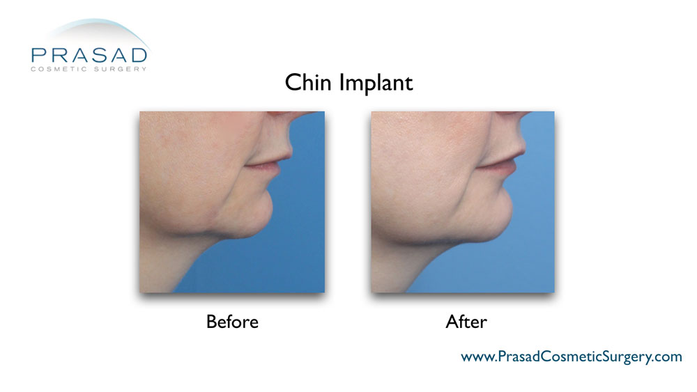chin implant before and after female procedure done by Dr. Prasad in NYC